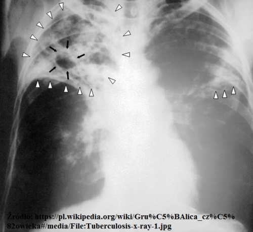 Tuberculosis-x-ray-1